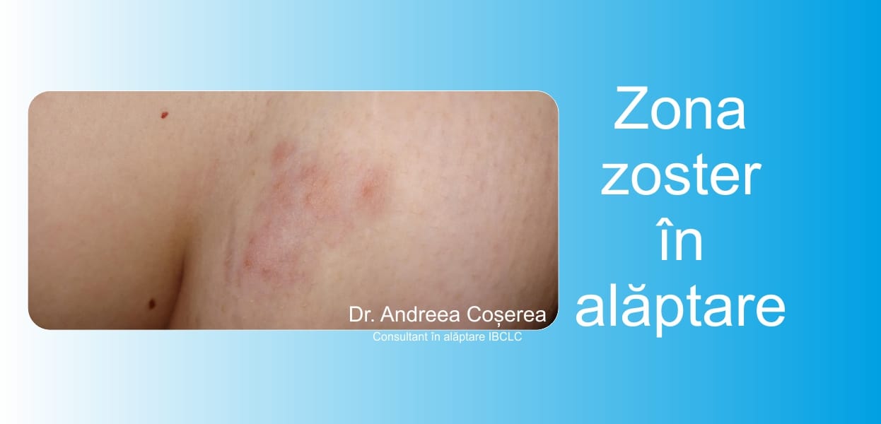 Zona zoster în alăptare